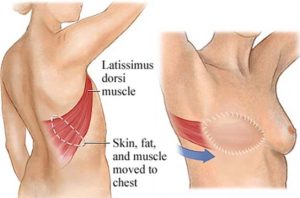 back flap reconstruction after mastectomy